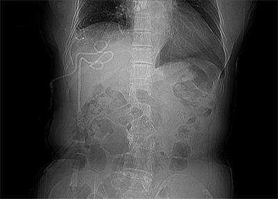 Double pigtail tube drainage for large multiloculated pyogenic liver abscesses